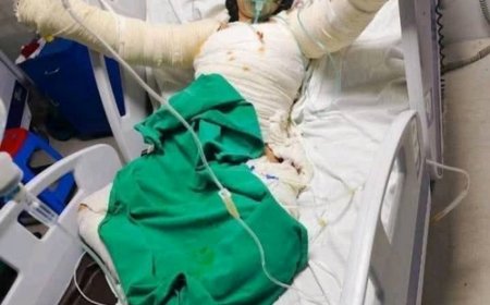 পোড়া রোগীর জন্য সতর্কতা